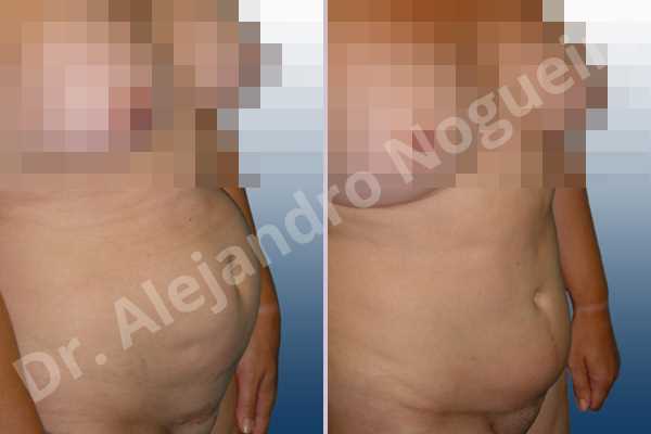 Abdomen descolgado,Cicatrices hundidas,Abdomen con debilidad muscular,Abdominoplastia estándar - photo 5