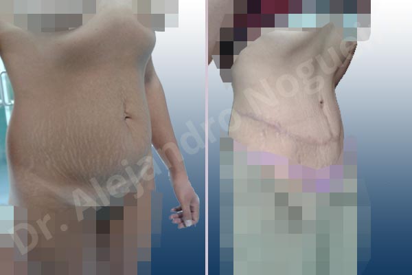 Abdomen descolgado,Abdomen con debilidad muscular,Abdominoplastia estándar - photo 10