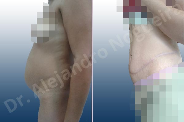 Abdomen descolgado,Abdomen con debilidad muscular,Abdominoplastia estándar - photo 3