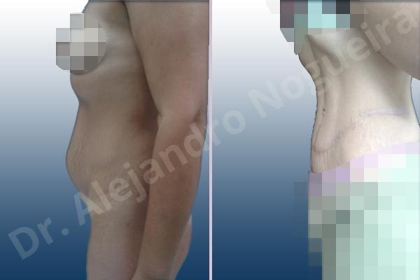 Abdomen descolgado,Abdomen con debilidad muscular,Abdominoplastia estándar - photo 4