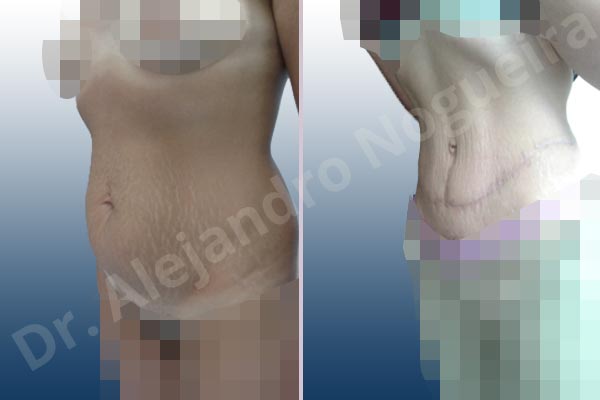 Abdomen descolgado,Abdomen con debilidad muscular,Abdominoplastia estándar - photo 6