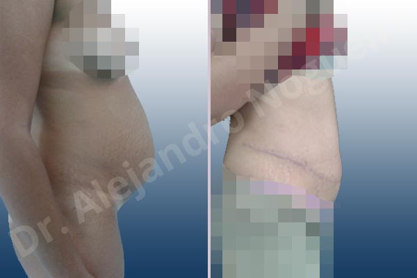 Abdomen descolgado,Abdomen con debilidad muscular,Abdominoplastia estándar - photo 7