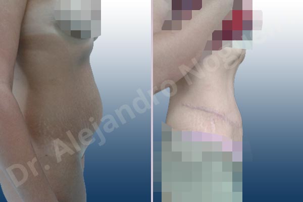 Abdomen descolgado,Abdomen con debilidad muscular,Abdominoplastia estándar - photo 8