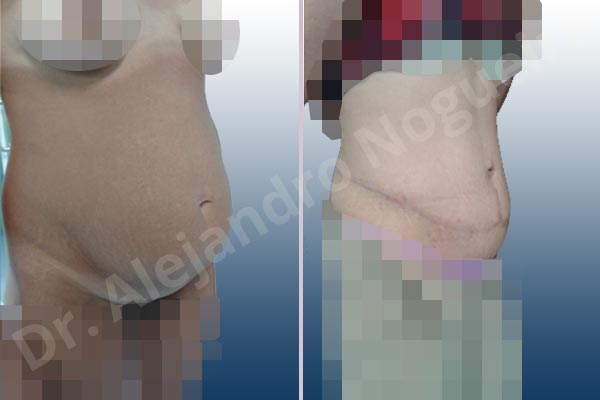 Abdomen descolgado,Abdomen con debilidad muscular,Abdominoplastia estándar - photo 9