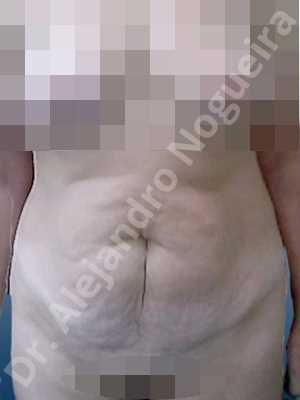Abdomen descolgado,Abdomen con debilidad muscular,Abdominoplastia estándar