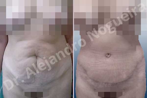 Abdomen descolgado,Abdomen con debilidad muscular,Abdominoplastia estándar - photo 1
