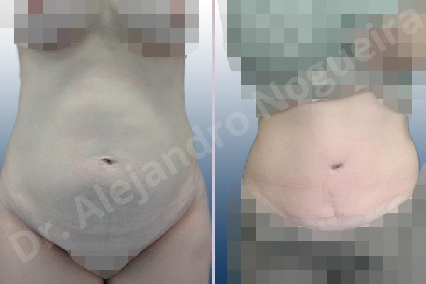 Abdomen descolgado,Abdomen con debilidad muscular,Abdominoplastia estándar - photo 1