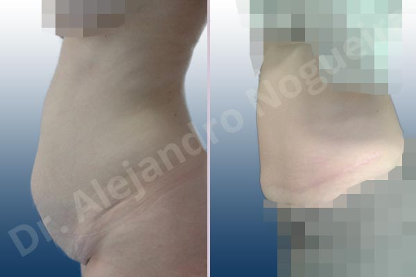 Abdomen descolgado,Abdomen con debilidad muscular,Abdominoplastia estándar - photo 2