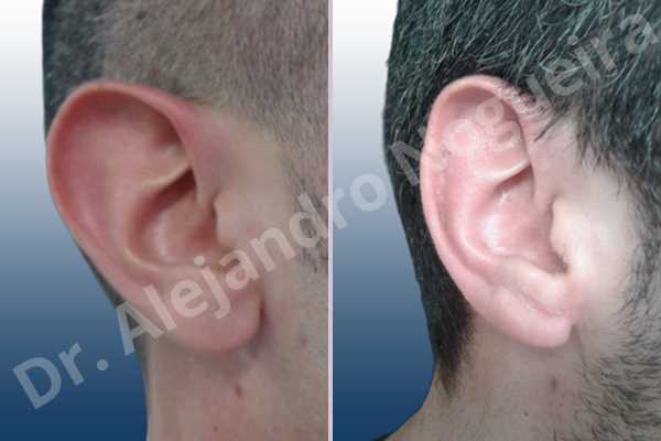 Lóbulos auriculares grandes,Orejas grandes,Lóbulos auriculares prominentes,Orejas prominentes,Resección auricular cefálica en flor de lys,Resección de lóbulo auricular en L - photo 5