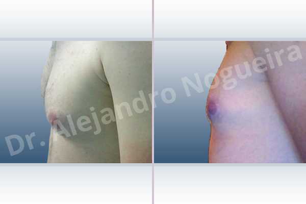 Ginecomastia,Incisión transareolar,Mastectomía subcutánea - photo 2