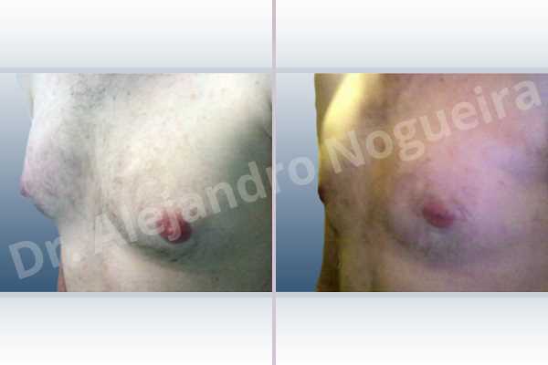 Ginecomastia,Incisión transareolar,Mastectomía subcutánea - photo 3