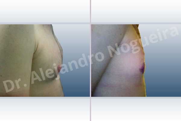 Ginecomastia,Incisión transareolar,Mastectomía subcutánea - photo 4