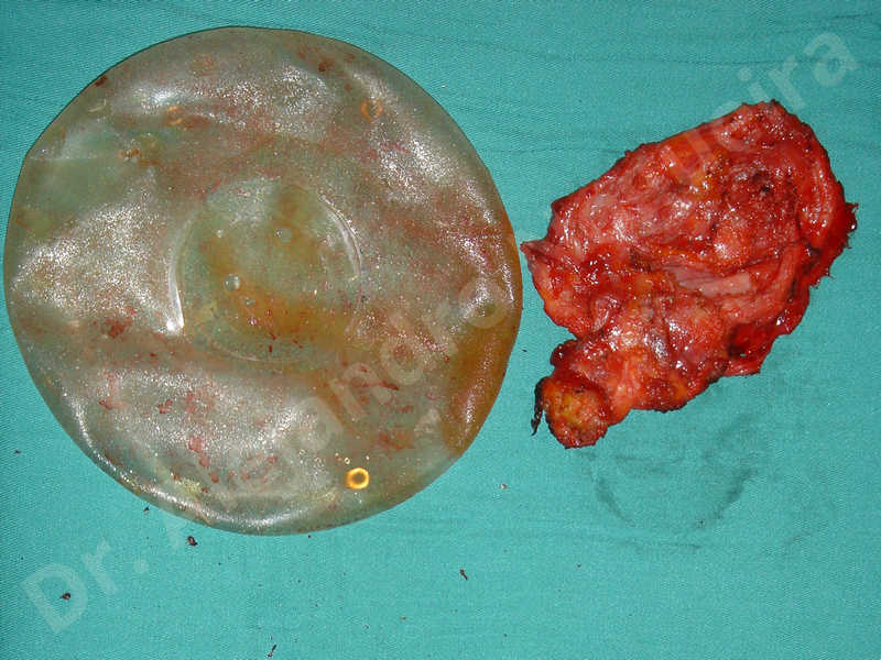 Pechos asimétricos,Implantes mamarios rotos,Pechos vacíos,Implantes mamarios demasiado estrechos,Capsulectomía - photo 3