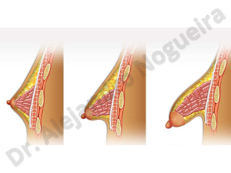 Areolas grandes,Pechos tuberosos,Reducción areolar,Mamoplastia tuberosa - photo 2