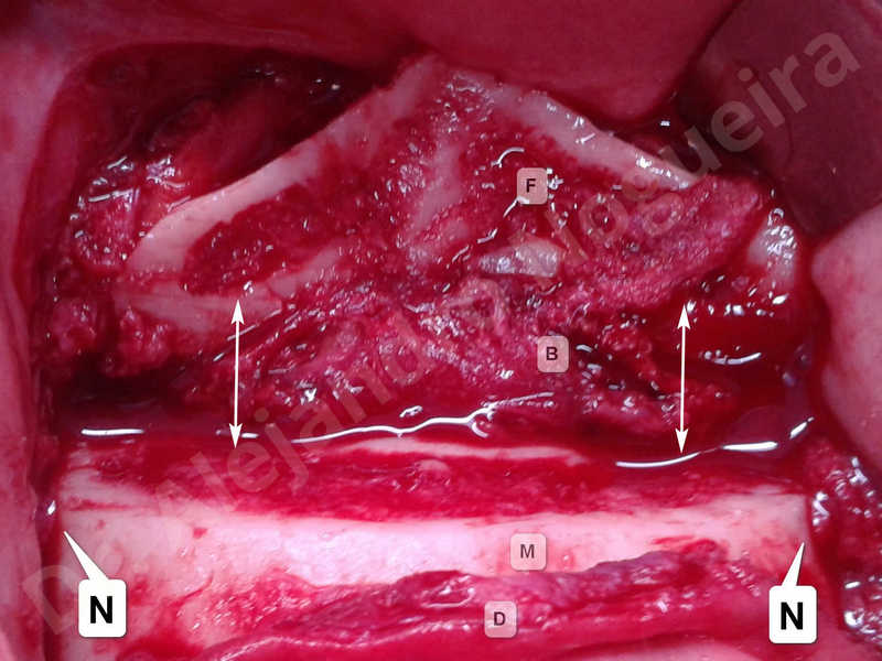 Mentón grande,Mentón prominente,Resección ósea horizontal de mentón,Osteotomía oblicua de mentón,Retroceso óseo de mentón,Genioplastia tridimensional,Resección ósea vertical de mentón - photo 11