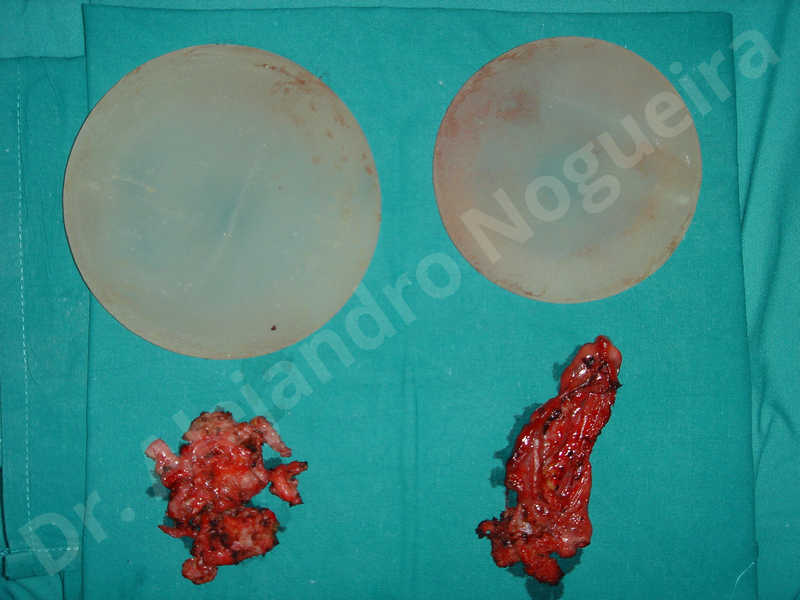 Contractura capsular de implantes mamarios,Pechos asimétricos,Pechos vacíos,Implantes mamarios demasiado estrechos,Capsulectomía - photo 2