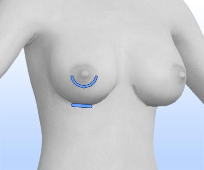 scars breast revision - I