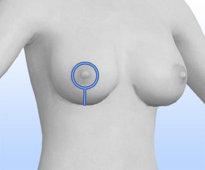 scars breast revision - II