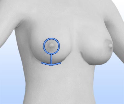 scars breast revision - III