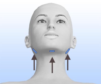 scars face and neck liposuction