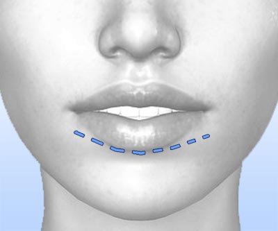 scars chin reduction