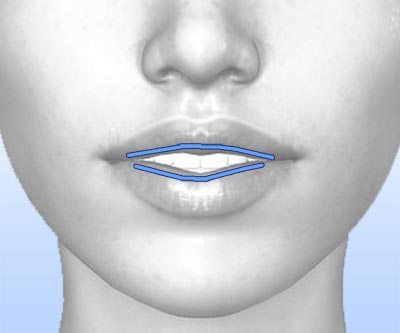 scars lip reduction