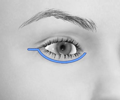 scars lower eye bags blepharoplasty - I