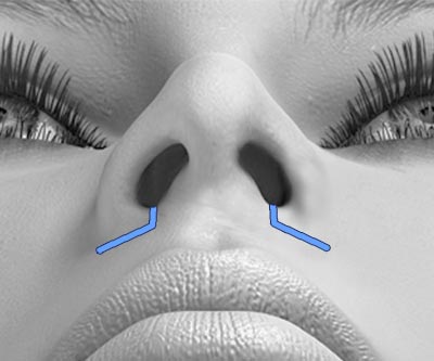 scars reduction rhinoplasty - II