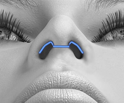 scars structure rhinoplasty - II