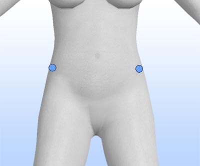 scars trunk liposuction