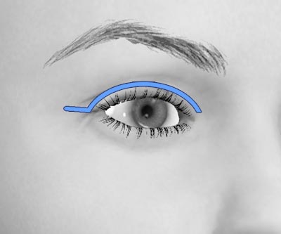 scars upper eye lift blepharoplasty - I