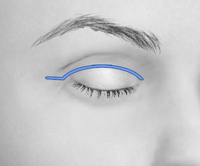 scars upper eye lift blepharoplasty - II